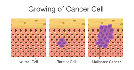 Growing of cancer cells in human. Medical illustration.のイラスト素材