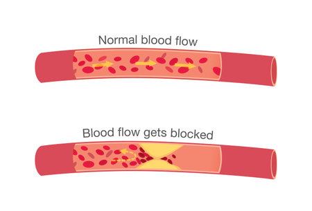 Blood flow in atherosclerosis in normal stages and when get blocked by fatty which that is cause angina and heart attack.のイラスト素材