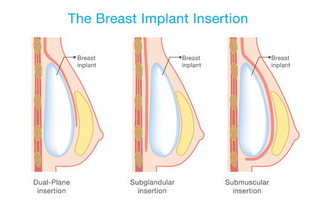 Diagram about method of insertion for breast implant. Cosmetic surgery illustration.のイラスト素材