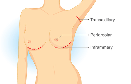 Incision points in breast implant surgery. Illustration about cosmetic surgery.のイラスト素材