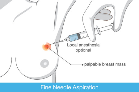 Woman get a fine needle aspiration is to test for breast cancer. Illustration about procedure of breast cancer tests.のイラスト素材