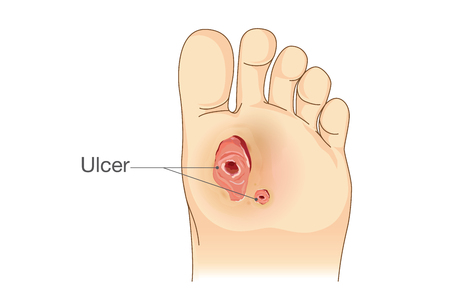 Diabetic Foot Pain and Ulcers. Skin Sores on Foot. Illustration about Diabetes Symptoms.のイラスト素材