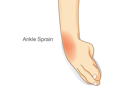 Ankle sprain and swelled. This illustration about common foot injuriesのイラスト素材