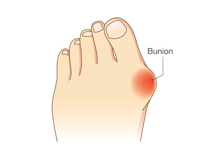 Bunion at sides of foot. Bone and skin on the sides of joint of the big toe make abnormal foot shape. Common problem form wearing high heel.のイラスト素材