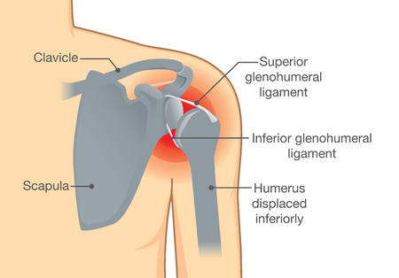 Dislocation Shoulder symptoms or separated. Bone and joints to slipping out of place.のイラスト素材