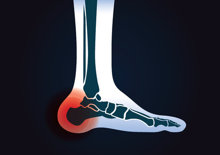 Red signal at heel area. This illustration about human foot injury.のイラスト素材