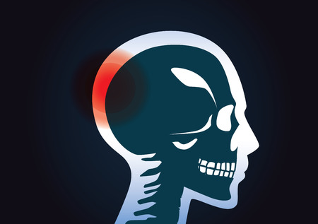 In head of human have a red signal. This illustration about a brain tumor.のイラスト素材