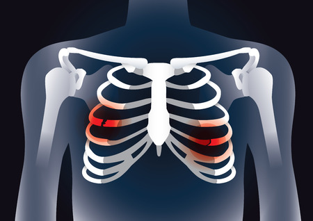 Red signal at the bones in rib cage break. Illustration about damage inside body.のイラスト素材
