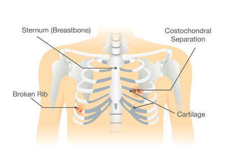 Human rib bone fractures fracture. Illustration is description of body injury.のイラスト素材