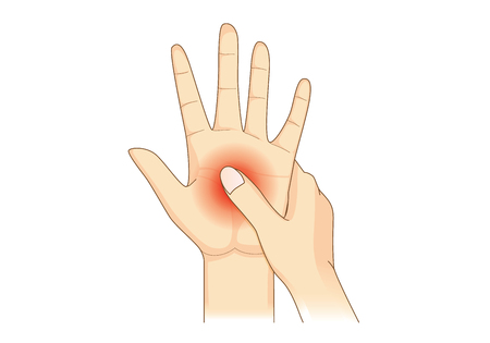 Numbness in one hand. Illustration about loss of sensation or feeling in hand or fingers.のイラスト素材
