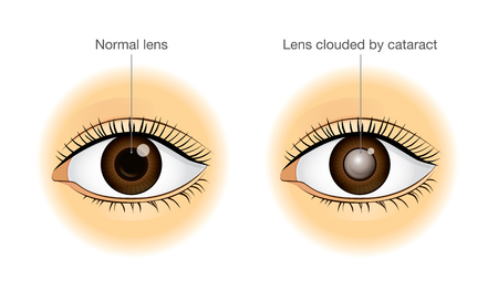 The difference between normal eye and lens clouded by cataract. Illustration about health and eyesight.のイラスト素材