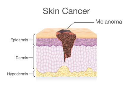 Spreading of Cancer Cell in Human Skin layer. Medical illustration.のイラスト素材