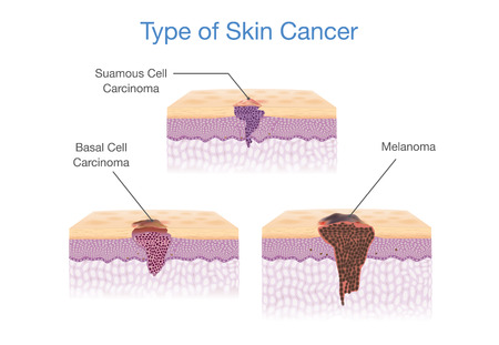 Type of Skin Cancer in 3D vector style. Medical illustration.のイラスト素材