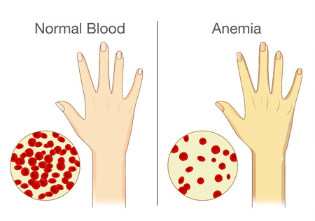 The effect of Anemia on skin blood flow in human. Compared color of people arm.のイラスト素材