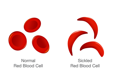 The difference of Normal red blood cell and sickle cell. Illustration about medical.のイラスト素材