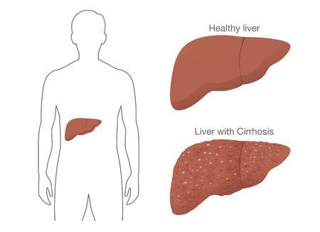 The Comparison between Healthy liver and Cirrhosis from drink alcohol. Illustration about symptom of patient.のイラスト素材