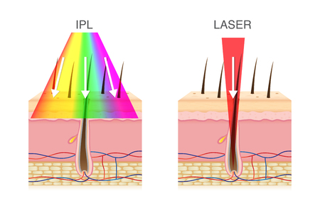 The difference of using IPL light and laser in hair removal. Illustration about beauty technology.のイラスト素材