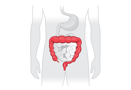 Illustration about abnormal symptom of human large Intestine. Disease about Digestive system.のイラスト素材