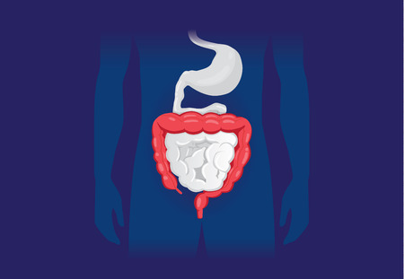 Illustration about abnormal symptom of human large Intestine. Disease about Digestive system.のイラスト素材
