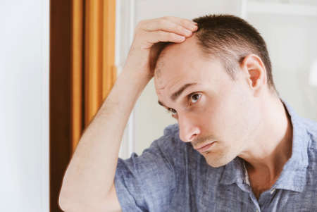 Male pattern hair loss problem concept. Young caucasian man looking at mirror worried about balding. Baldness, alopecia in males.の写真素材