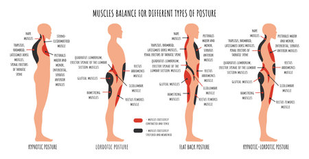 Comparison of muscle imbalance in various postural disorders. Kyphotic, lordotic, flat back posture infographics. The side view shows characteristic stretched and weakened, shortened and tens musclesのイラスト素材