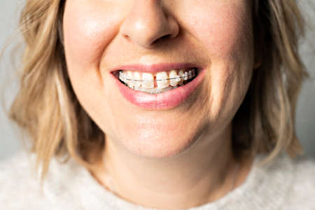 Braces teeth mouth orthodontics woman close view