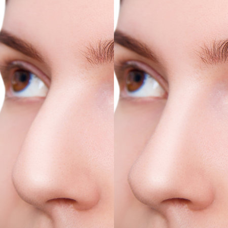 Comparative portrait of female nose before and after plastic surgery.の写真素材