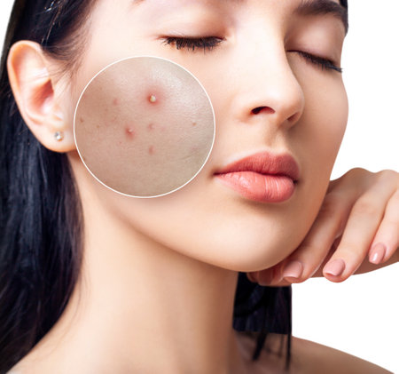 Face of young woman with zoom circle before and after acne treatment. Beautician concept.の写真素材
