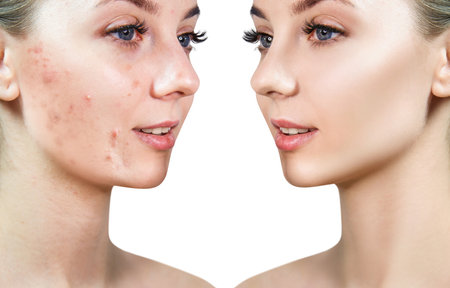 Face of beautiful woman before and after acne treatment. Beautician concept.の写真素材