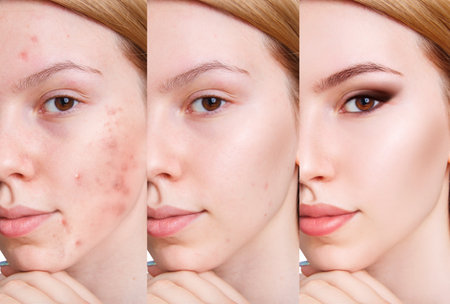 Face of beautiful woman before and after acne treatment and make-up step by step. Beautician concept.の写真素材