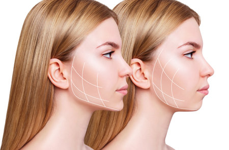 Young woman with lifting lines before and after chin correction. Over white background.