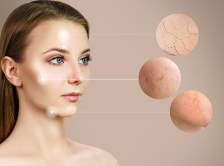 Magnifying circles demonstrate couperose and acne on face skin of young woman. Over beige background.の写真素材