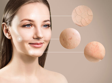 Magnifying circles demonstrate couperose and acne on face skin of young woman. Over beige background.の写真素材
