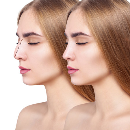 Comparative portrait of female nose before and after plastic surgery.の写真素材