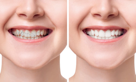 Young woman smiling before and after teeth treatment. Dental health concept.の写真素材