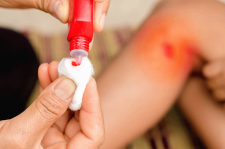 Child injured. Close up wound on child leg. Mother dressing child's leg after Children have been an accidentの写真素材