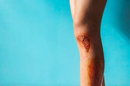 isolated wounded leg on blue backgroundの写真素材