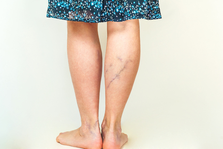 Examination of varicose veins on the womans legsの写真素材