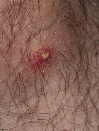 macro shot capturing a pustule on human skin, nestled among hairs, vividly portraying the raw and often painful reality of skin infectionsの写真素材