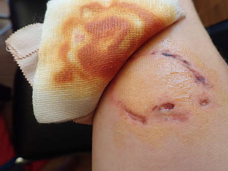detail of a dog bite wound on a hand with iodine desinfection