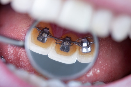 
invisible lingual braces on dental mirrorの写真素材