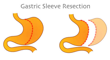 Gastric Sleeve Resection. Vertical stomach reduction bypass, operation. Tube fat surgery. Cross section anatomy, diagram. Cut marks. Weight loss, slimming. Medical illustration draw vectorのイラスト素材
