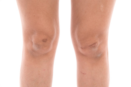 Close up scars on woman legs isolated