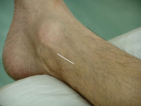 Acupuncture in an legの写真素材