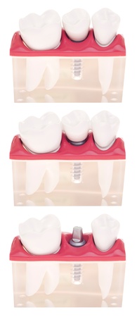 dental model with different types of treatments (implant placement, bonded bridge, crown over implant) isolated on white backgroundの写真素材