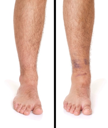 young male with sprained ankle isolated on white background (healthy vs unhealthy)の写真素材