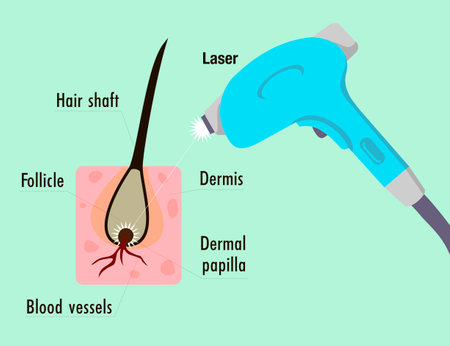 Laser hair removal. Depilation procedure. Device for shaving unwanted hair. Epilator. Hair structureのイラスト素材