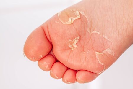After the red rash and the strawberry tongue caused by scarlet fever the affected skin often peels - Here Skin of foot peelingの写真素材