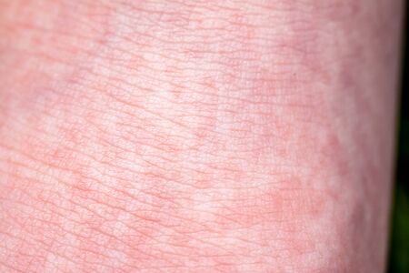 Scarlet Fever starts with a red rush and the strawberry tongue Afterwards the affected skin often peels - Here red skin rushの写真素材