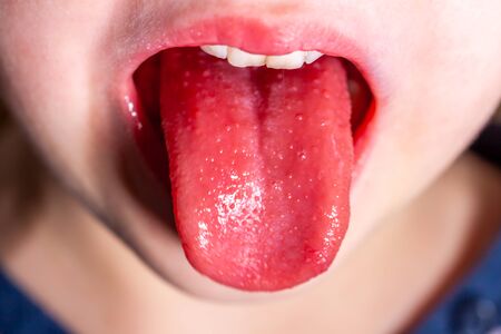 Tongue of a child with scarlet fever - strawberry tongueの写真素材